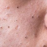 Tout savoir sur l'acné