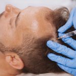 Quand envisager de faire une greffe de cheveux ?