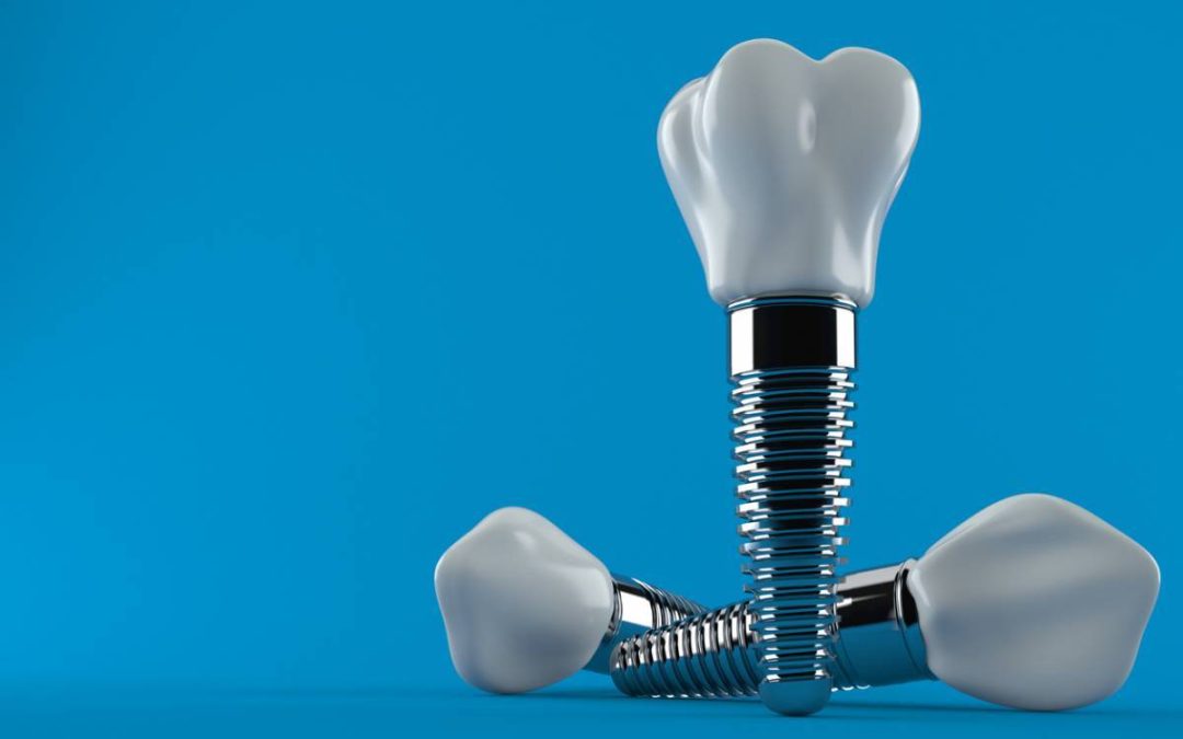 Implants dentaires : est-ce douloureux ?