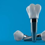 Implants dentaires : est-ce douloureux ?